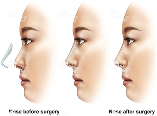 假體隆鼻手術(shù)前后對(duì)比