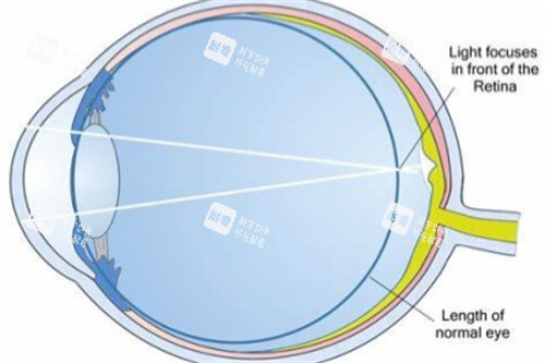 屈光不正近視示意圖