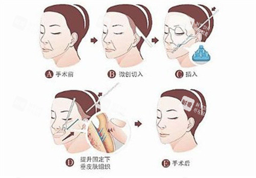 筋膜懸吊手術(shù)過程 筋膜懸吊手術(shù)過程