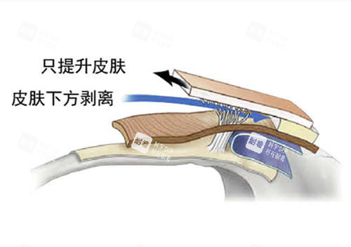 SMAS筋膜層圖片 SMAS筋膜層圖片