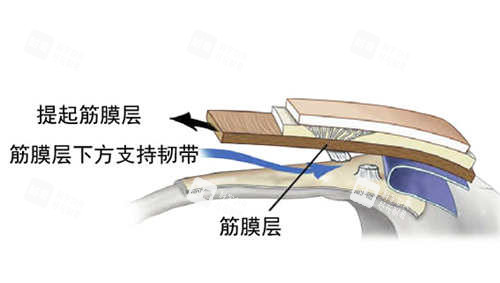 SMAS筋膜層圖片展示 SMAS筋膜層圖片展示