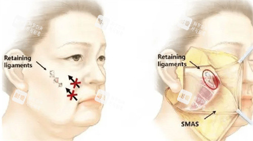 筋膜懸吊怎么做的 筋膜懸吊怎么做的
