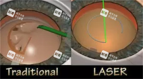 全飛秒手術(shù)操作過程圖解