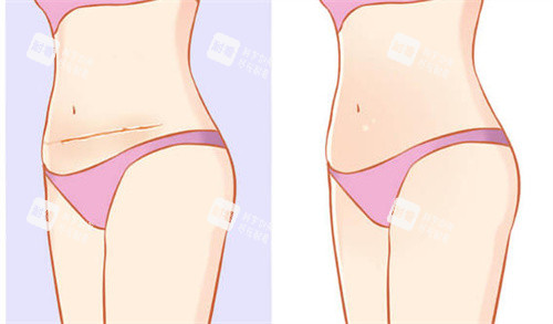 剖腹產(chǎn)疤痕修復(fù)前后對(duì)比