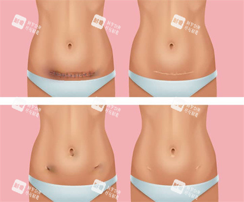 剖腹產(chǎn)疤痕修復(fù)過程