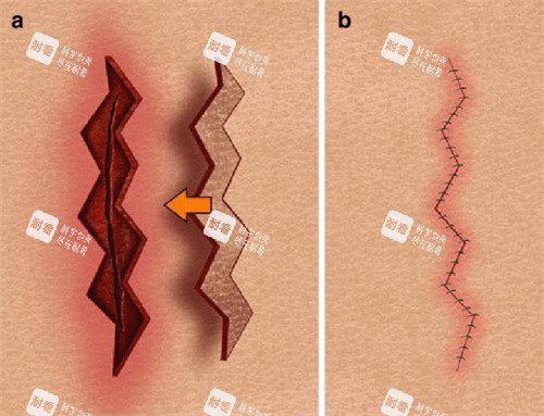 疤痕修復(fù)縫合