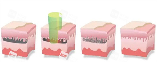 青島洗紋身哪家醫(yī)院好?這三家口碑機(jī)構(gòu)讓你告別紋身煩惱,激光清洗無殘留