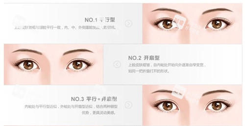 雙眼皮的類(lèi)型
