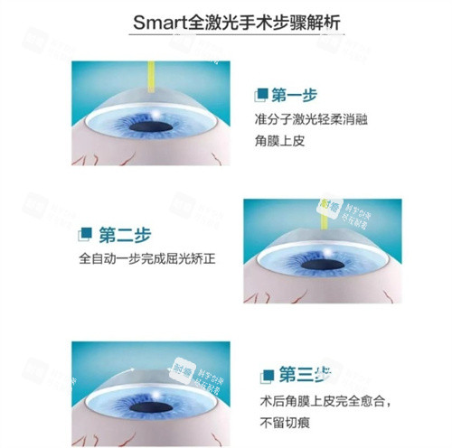 全激光smart手術步驟
