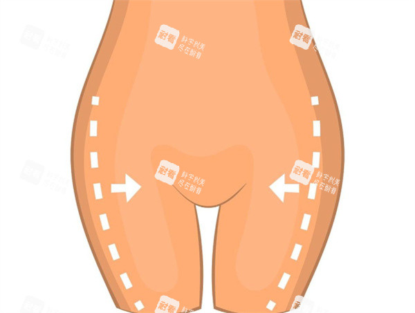 大腿吸脂手術(shù)卡通圖