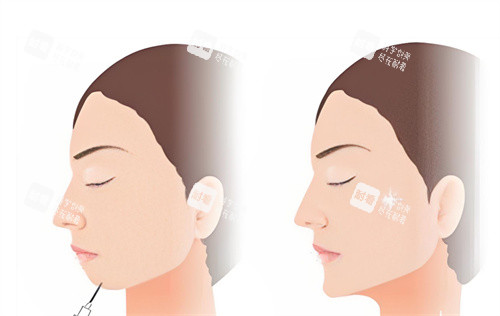 下巴注射前后對(duì)比卡通圖