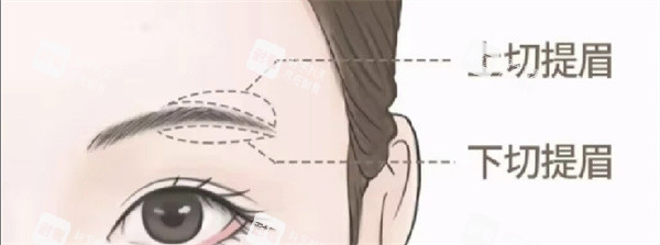 提眉術(shù)