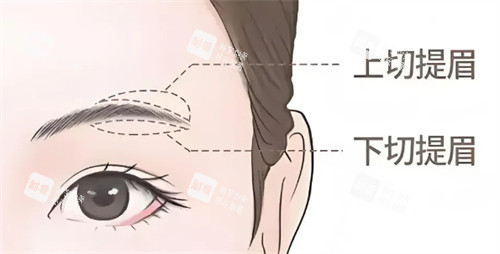 提眉術(shù)式區(qū)別