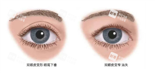 什么情況下要提眉