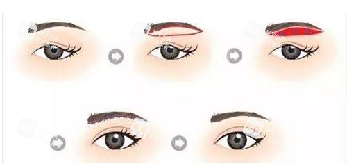 提眉手術(shù)步驟示意圖