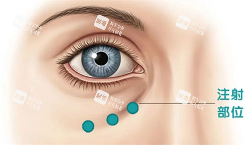 淚溝注射部位示意圖
