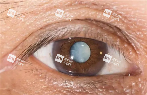 白內(nèi)障眼球圖