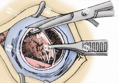 眼角膜割除動畫展示