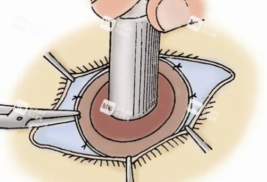 眼角膜移植手術(shù)操作展示
