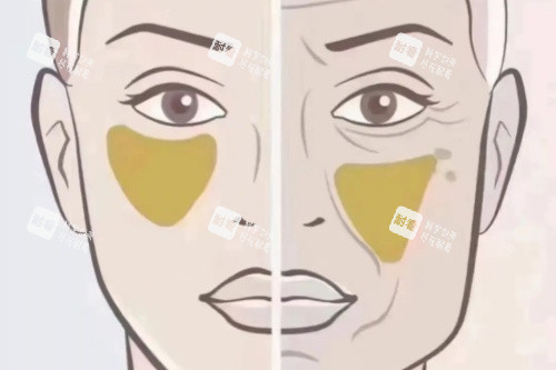 蘋果肌下垂卡通對比圖