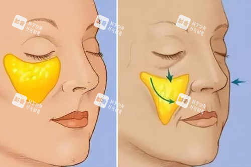 蘋果肌下垂于正常蘋果肌卡通對比圖