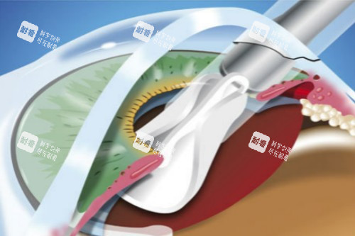 白內(nèi)障超聲乳化術(shù)