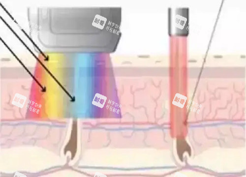 激光祛疤作用光波示意圖