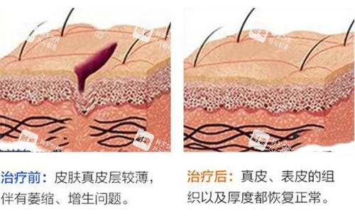 激光祛疤前后對比示意圖