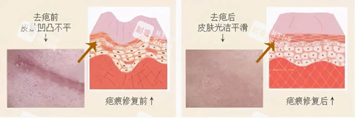 激光祛疤卡通示意圖