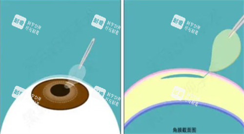 激光近視手術過程圖解 激光近視手術過程圖解