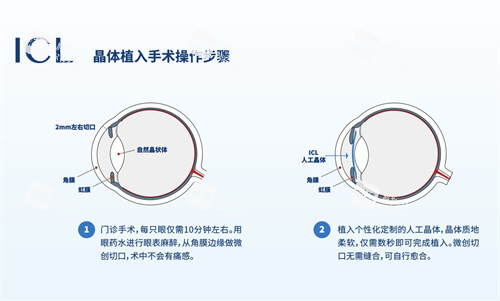 icl晶體植入術(shù)手術(shù)步驟漫畫圖 icl晶體植入術(shù)手術(shù)步驟漫畫圖