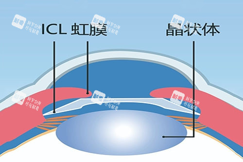 ICL晶體植入卡通圖 ICL晶體植入卡通圖