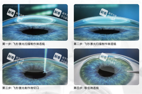 全飛秒手術(shù)圖 全飛秒手術(shù)圖