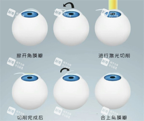 半飛秒手術(shù)過程 半飛秒手術(shù)過程