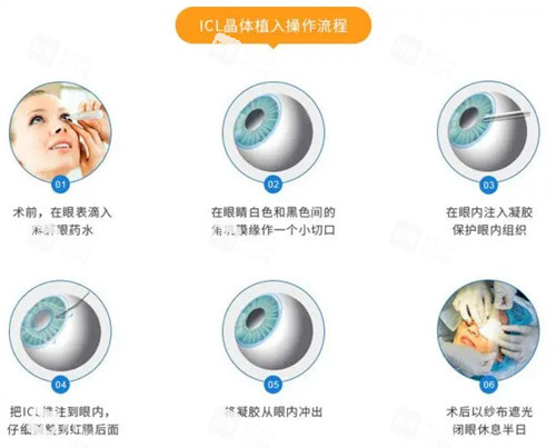 ICL晶體植入手術(shù)流程 ICL晶體植入手術(shù)流程