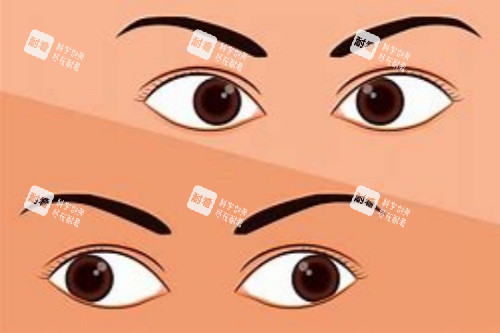 內(nèi)斜視對(duì)比外斜視 內(nèi)斜視對(duì)比外斜視