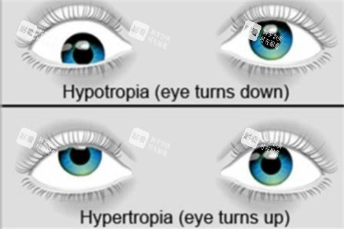 上下斜視 上下斜視