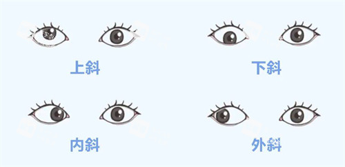 上斜下斜內(nèi)斜外斜的區(qū)別 上斜下斜內(nèi)斜外斜的區(qū)別