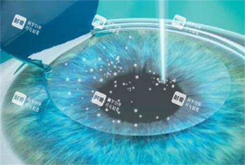 綠飛秒近視手術(shù)過(guò)程圖解 綠飛秒近視手術(shù)過(guò)程圖解