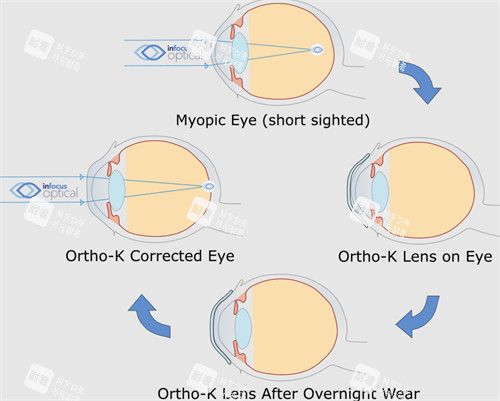 OK鏡改善眼表過(guò)程 OK鏡改善眼表過(guò)程