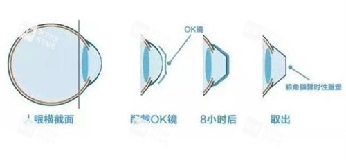 佩戴OK鏡的原理 佩戴OK鏡的原理