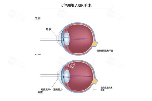 近視眼手術(shù)視線前后對(duì)比圖 近視眼手術(shù)視線前后對(duì)比圖