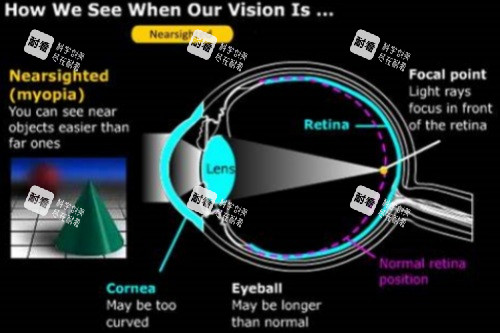 近視眼球結(jié)構(gòu) 近視眼球結(jié)構(gòu)