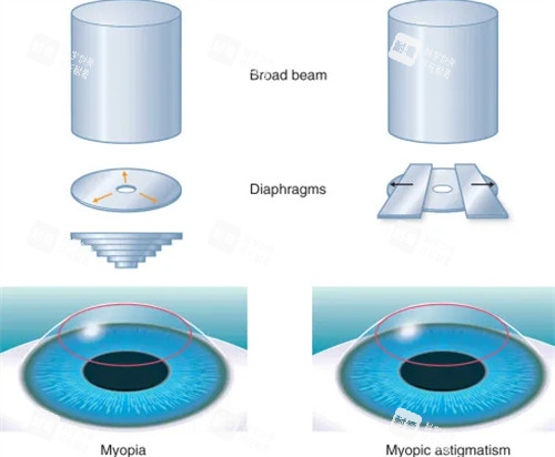 近視手術(shù)流程 近視手術(shù)流程