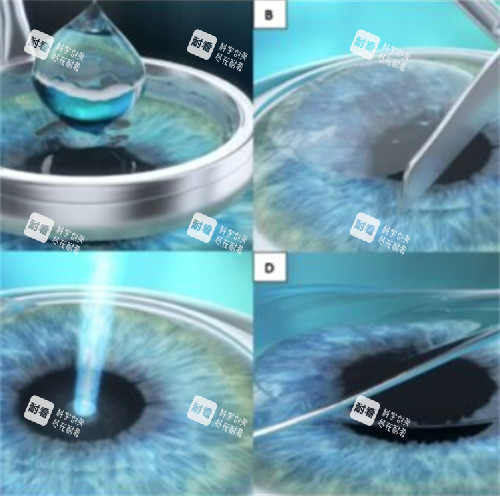 近視手術(shù)過(guò)程 近視手術(shù)過(guò)程