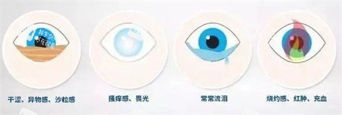 近視手術(shù)后干眼癥的癥狀2 近視手術(shù)后干眼癥的癥狀2