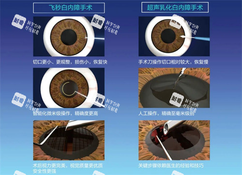 飛秒白內(nèi)障手術(shù)過(guò)程圖 飛秒白內(nèi)障手術(shù)過(guò)程圖