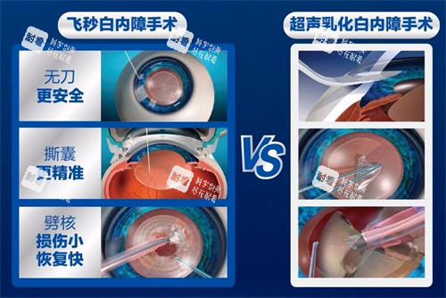 飛秒白內(nèi)障手術(shù)過(guò)程 飛秒白內(nèi)障手術(shù)過(guò)程