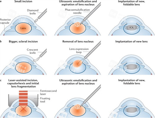 超聲乳化白內(nèi)障手術(shù)的流程圖 超聲乳化白內(nèi)障手術(shù)的流程圖