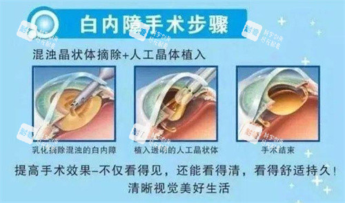 白內(nèi)障手術(shù)示意圖 白內(nèi)障手術(shù)示意圖